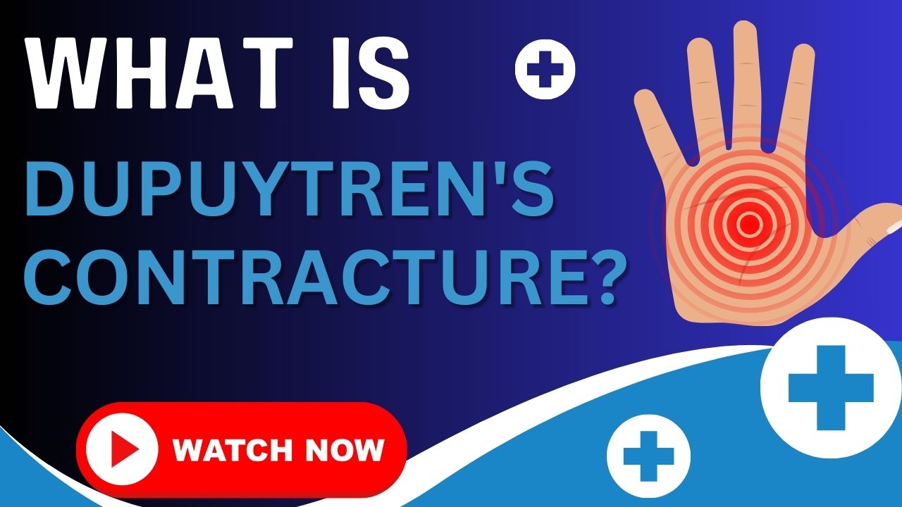 Dupuytren's Contracture